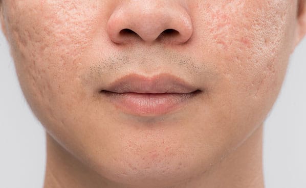 Acne Scarring and Stretch Marks