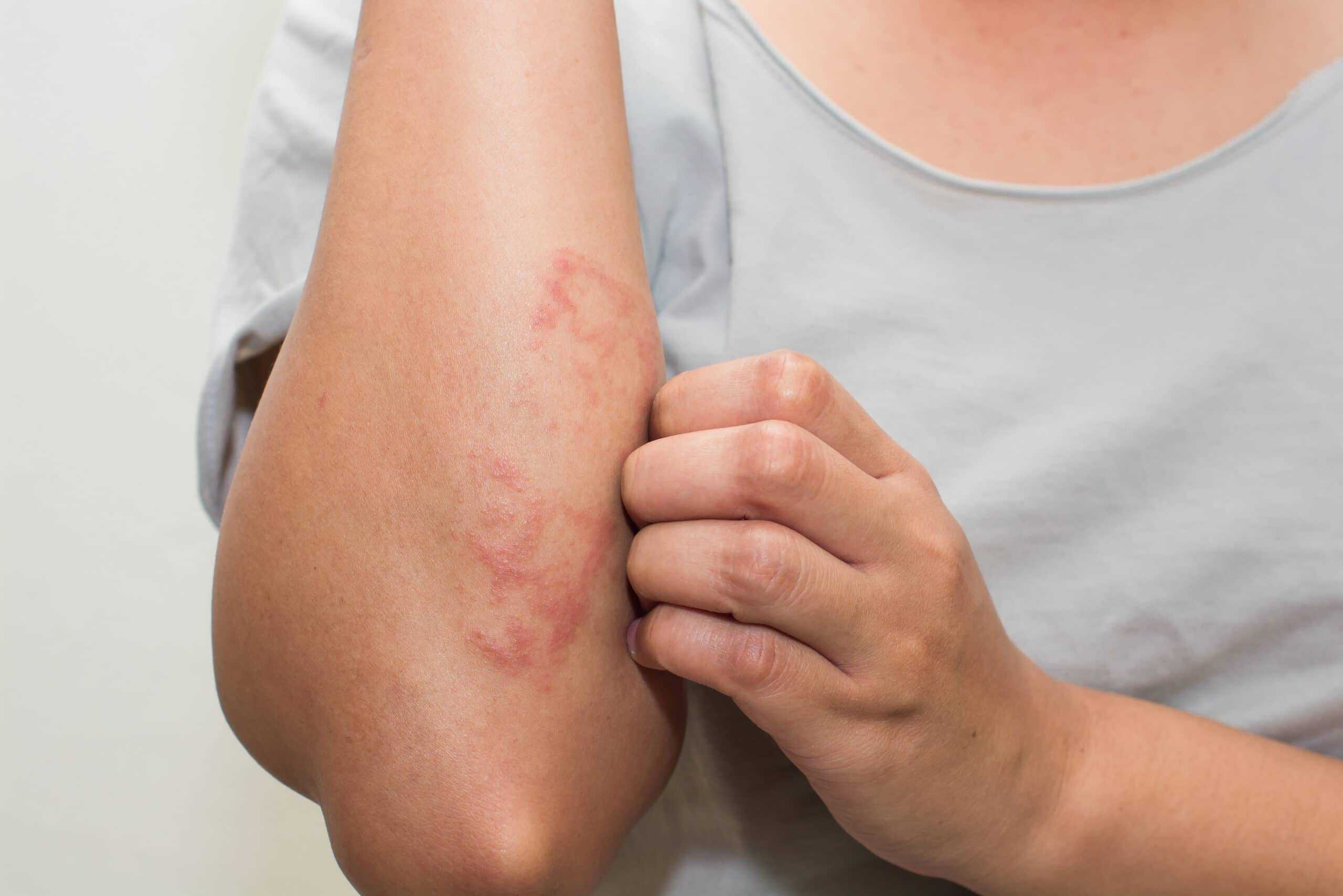 Eczema shutterstock 522715072 scaled 1