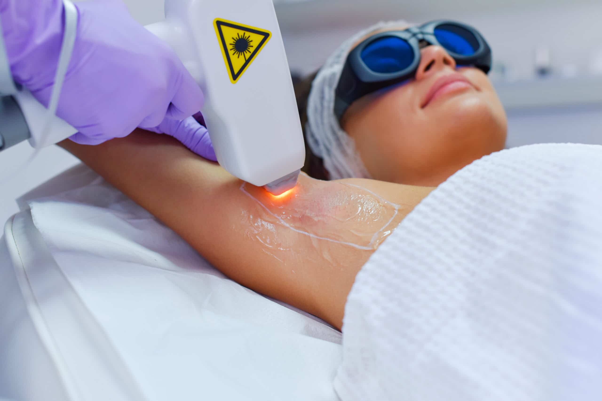 Laser hair removal