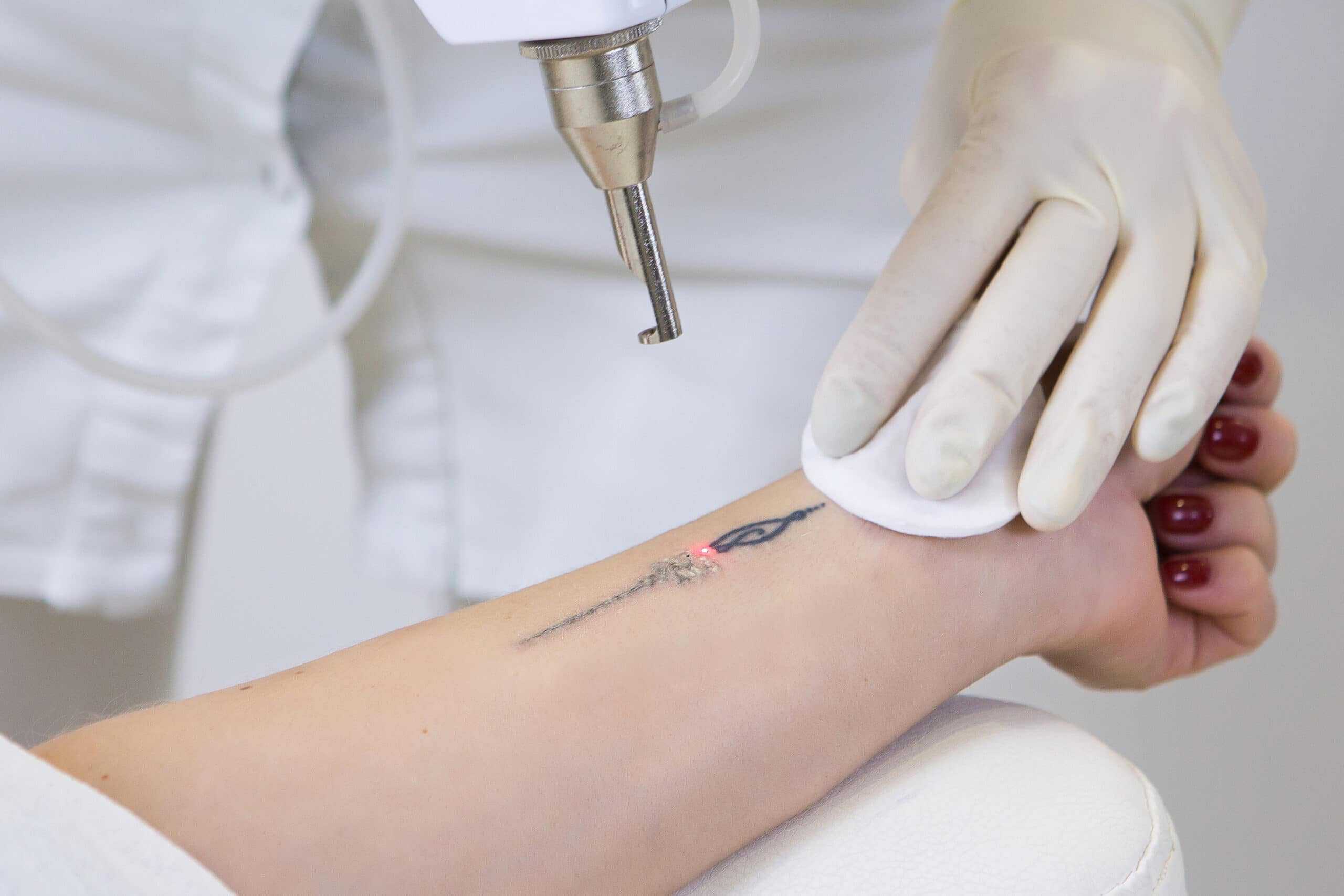 LASER Tattoo Removal Tattoo Surgery and other methods All you need to  Know  Visakha Institute of Skin And Allergy