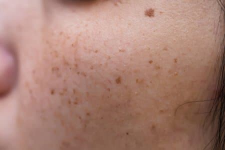 depositphotos 277558728 stock photo woman problematic skin acne scars