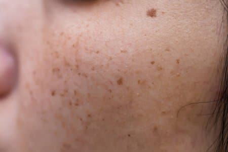 What Are Sunspots on the Skin and How Should I Treat Them?