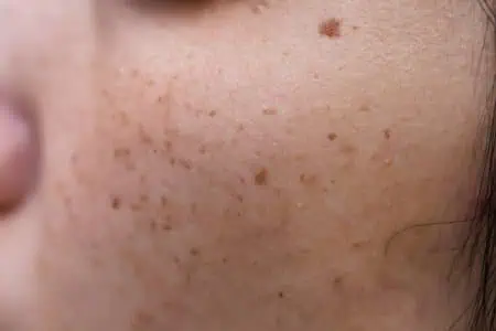 depositphotos 277558728 stock photo woman problematic skin acne scars