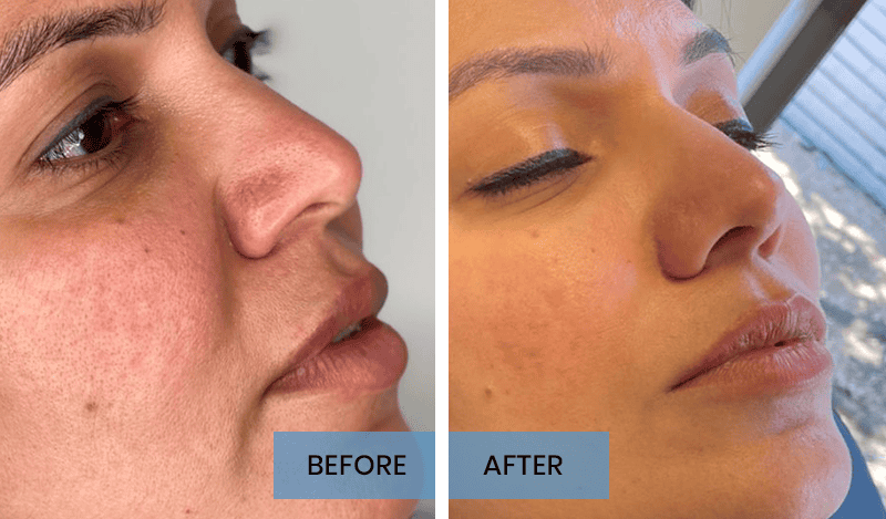Blog Lip Filler 01 copy 1