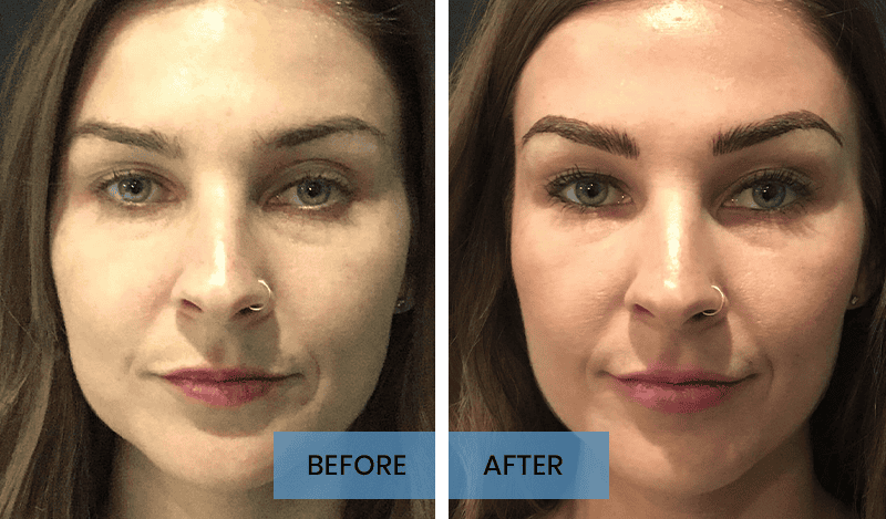 Chin Filler