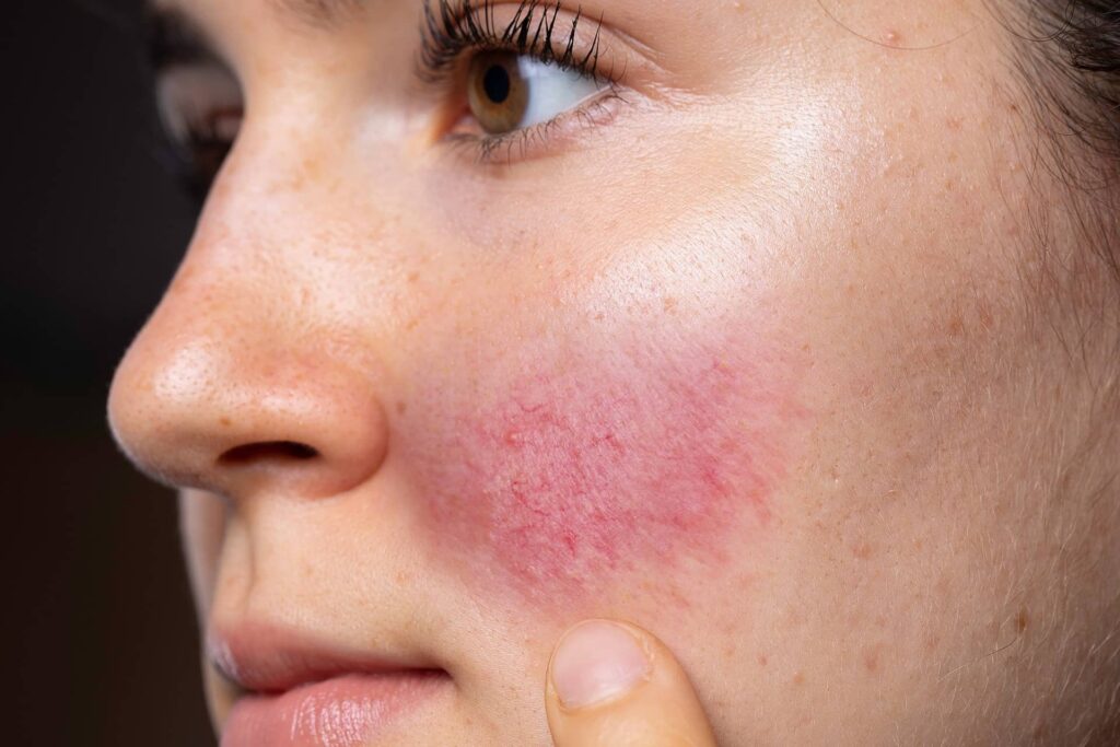 ROSACEA AND SKIN REDNESS