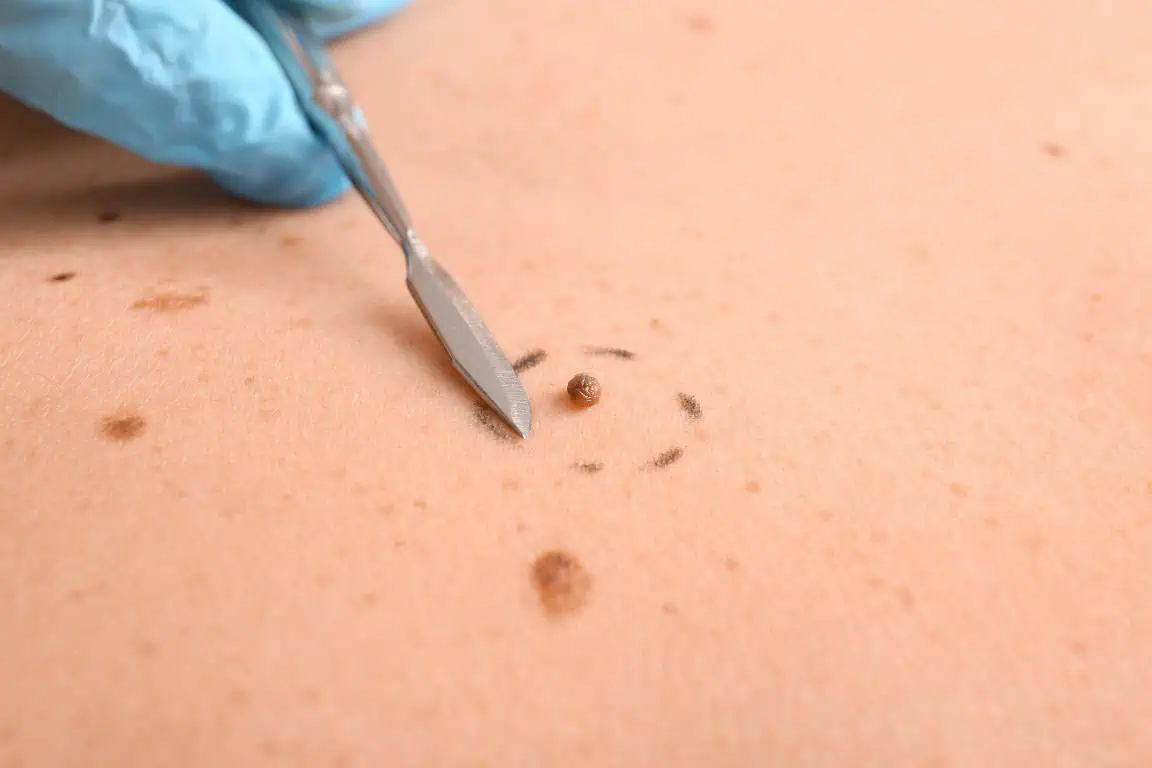 skin tag removal