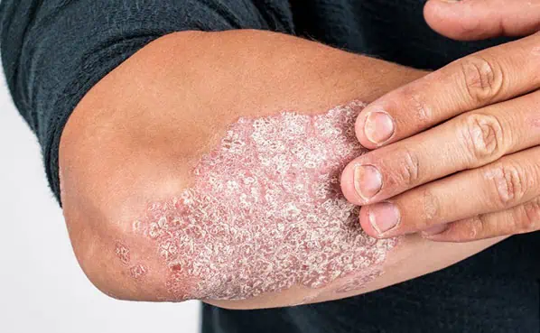 Psoriasis Clinic Melbourne