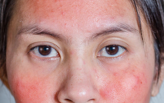 5 Reasons Why Your Skin May Be Turning Red