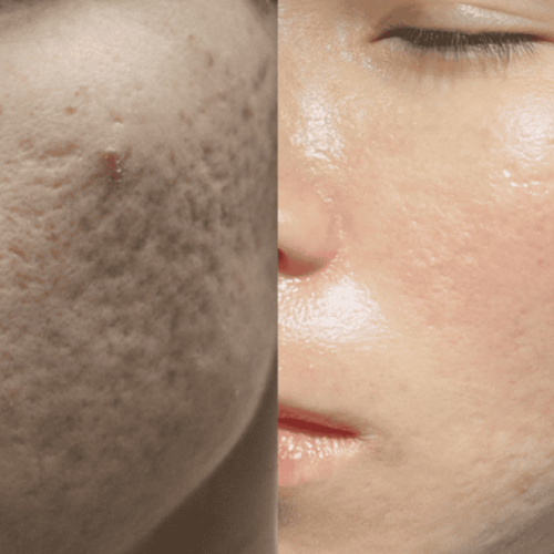 Acne Scar Treatment Melbourne